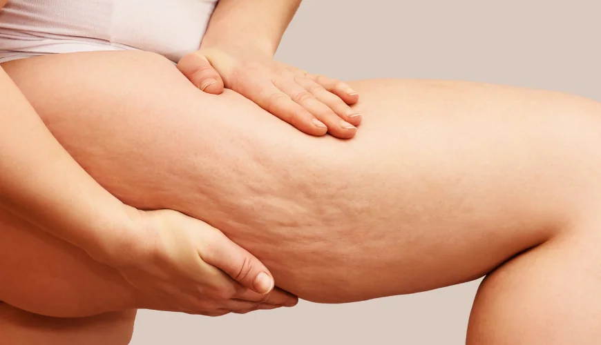 Erfolgreiche Lipödem Behandlung: Erfahrungsberichte und Tipps